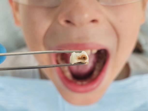 Best Emergency Dental Care for Sports Injuries in Orofino, ID